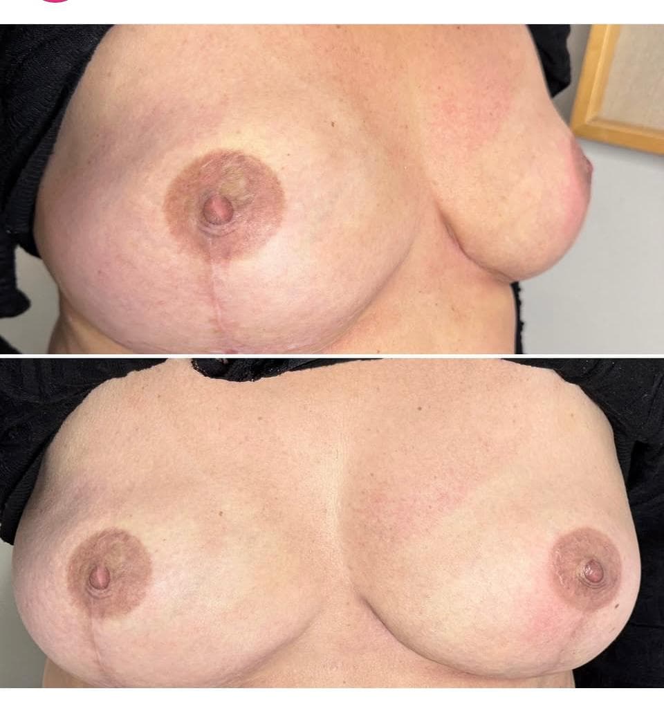 Areolas 3D en casos oncológicos - Imagen 1