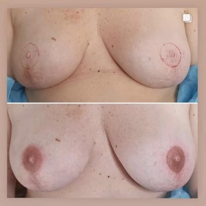 Areolas 3D en casos oncológicos - Imagen 4