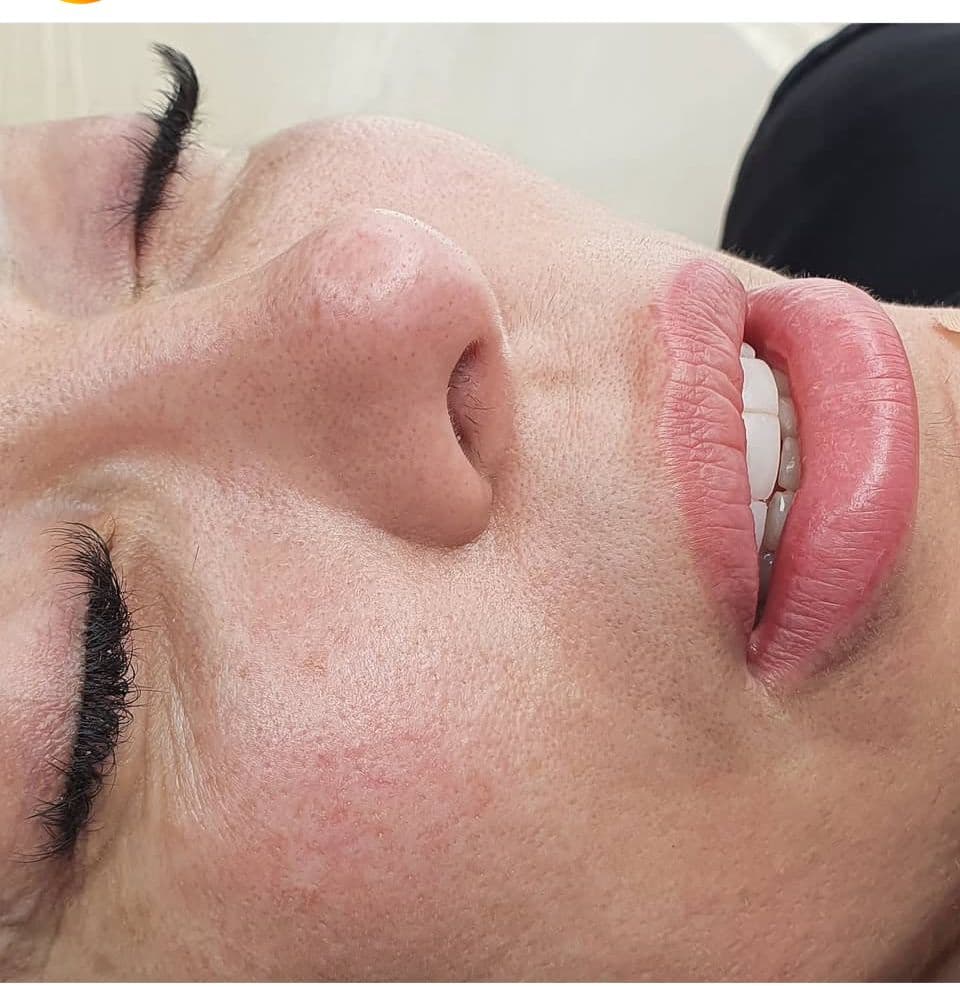 Dermo en labios - Imagen 2