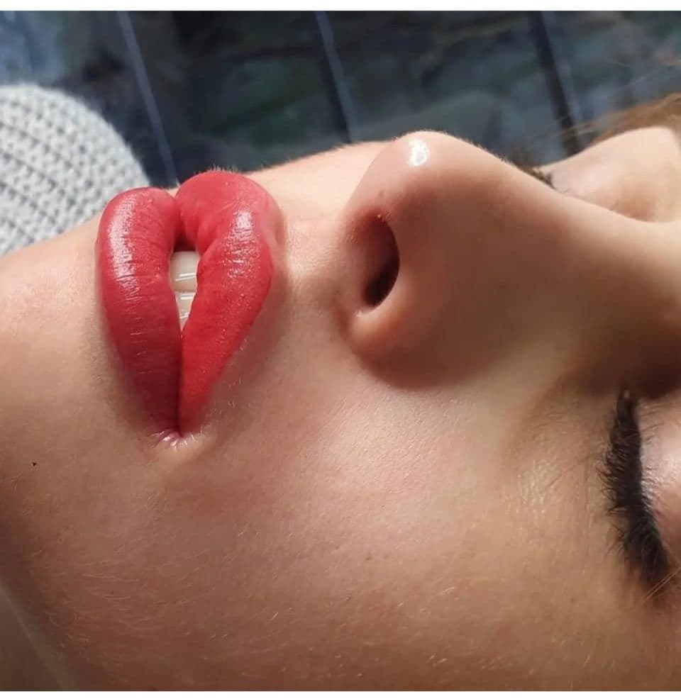 Dermo en labios - Imagen 4