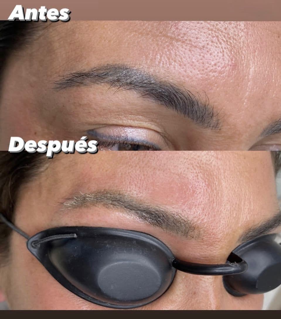 Láser removal - Imagen 3